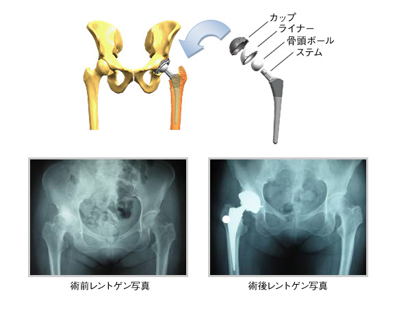 人工股関節：術前・術後