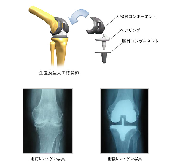 図：全置換型人工股関節・術前・術後