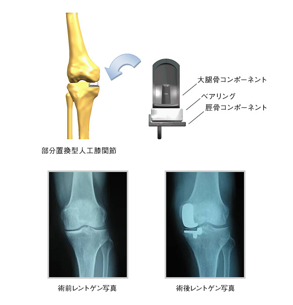 図：部分置換型人工股関節・術前・術後