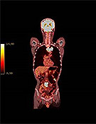 PET/CT Fusion