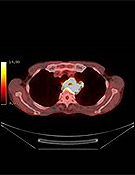 PET/CT Fusion